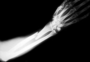 do i need a broken bone to have a personal injury case