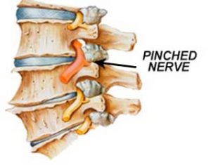 Pinched nerves caused by auto accidents