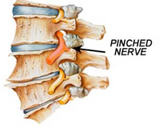 Pinched Nerves caused by car accidents